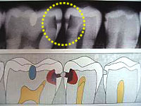 隠れ虫歯レントゲン