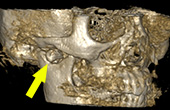 CT撮影による顎関節画像