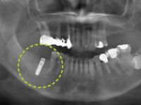インプラントが埋入されました