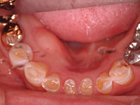 下の前歯の状態