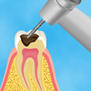 虫歯治療