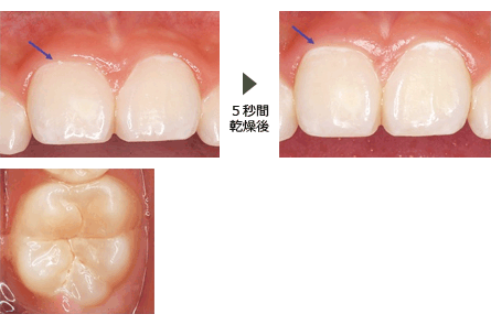 ICDASⅡ コード1