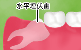 水平埋伏歯