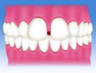 すきっ歯・空隙歯列