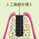 インプラント体を埋入します