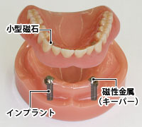 マグネットデンチャー